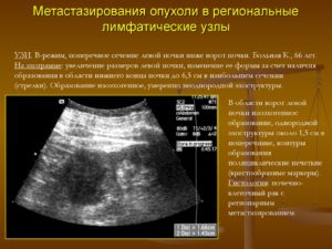 Общие подвздошные лимфатические узлы. Метастазы в лимфоузлах. Диагностика лимфаденопатии лимфоузла