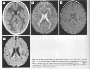 Лейкодистрофия (прогрессирующий склероз мозга). Что за болезнь лейкодистрофия Пелицеуса — Мерцбахера? Лейкодистрофия симптомы