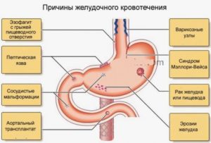 Остановка желудка симптомы и причины. Причины возникновения и признаки непроходимости желудка