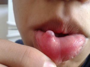 Гнойник во рту на губе. Что делать, если появилась болячка на губе? Что это может быть