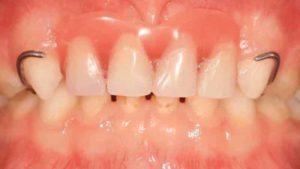 Делают ли протезирование молочных зубов? Протезирование зубов у детей