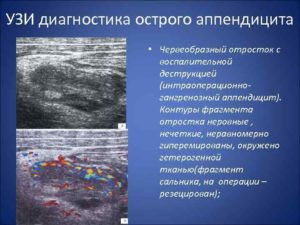 Можно ли диагностировать аппендицит по узи. Что показывает исследование? Атипичные положения аппендикса