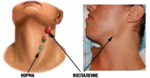 Какой врач лечит воспаление лимфоузлов на шее, к кому обратится? Лимфоузлы какой врач