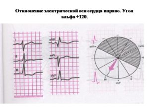 Синусовый ритм отклонение эос вправо у ребенка. Что такое электрическая ось сердца и какие могут быть последствия отклонений от нормы? Измерение показателей электрокардиографией