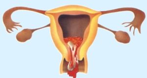 Слизь с кровью после медикаментозного прерывания беременности. Сколько идет кровь после медикаментозного прерывания беременности