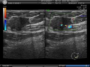 Узи молочной железы с цдк что это