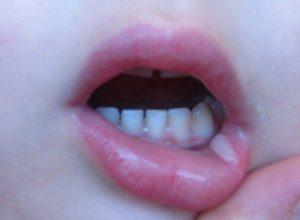 Белые волдыри на губах у ребенка. На губе большой пузырь