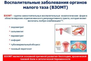 Воспаление малого таза у женщин. Воспаление органов малого таза: причины возникновения проблемы