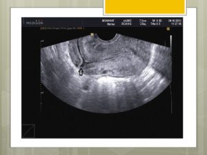 Узи шва после кесарева сечения когда делать. Как делают УЗИ матки после родов и какова норма основных показателей