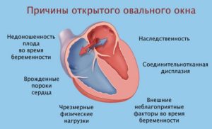 Овальное окно 9 лет может ли закрыться. Если у ребенка обнаружили открытое овальное окно в сердце