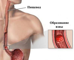 Тяжесть в пищеводе и желудке. Дискомфорт в пищеводе