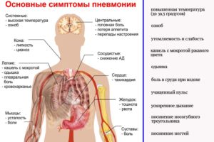 В наше можно ли умереть от пневмонии? Можно ли умереть от воспаления легких