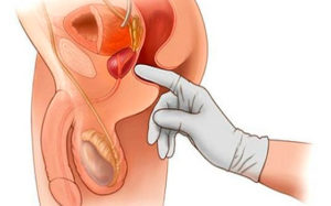 Как сделать массаж предстательной железы дома. Массаж простаты дома — за и против