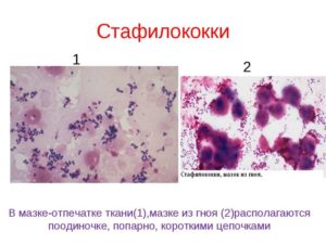 Лечение стафилококковой стрептококковой инфекции матки. Золотистый стафилококк у женщин в мазке