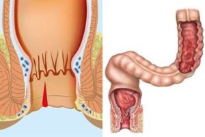 После родов трещинка в заднем проходе геморой причины кровит. Как лечить трещины в заднем проходе после родов