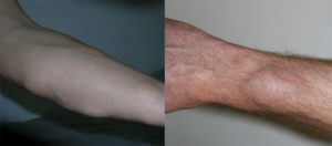 На мышце руки уплотнение. Причины появления подкожных шишек на теле человека