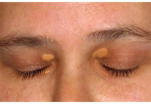 Как убрать холестериновые бляшки под глазами? Основные методы избавления от холестериновых бляшек под глазами