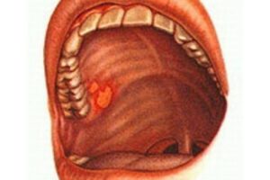 Абсцесс на десне и небе. Лечение народными средствами. Язвочка на небе во рту – что это и почему возникает