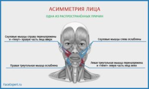 Асимметрия лица: причины и лечение. Причины асимметрии лица и методы лечения