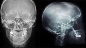 Рентгенография черепа: показания и особенности проведения исследования. Рентген головы: что показывает Обзорная рентгенография черепа