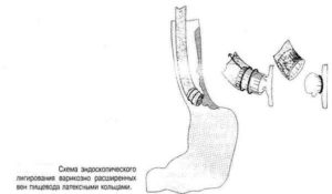 Эндоскопическое лигирование варикозно расширенных вен пищевода. Особенности легирования вен пищевода Лигирование поверхностных сосудов в ране