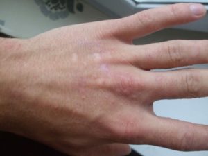 Опухли пальцы на руках и чешутся: причины. Аллергия на руках: виды, симптомы и лечение
