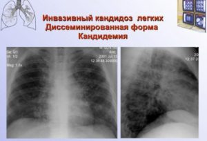 Бронхолегочный кандидоз. Кандидоз легких: симптомы, диагностика, лечение, народные рецепты