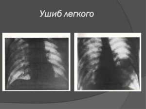 Ранение легкого. Повреждения лёгких