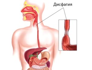 Чем причина когда плохо глотать пищу. Нарушение глотания