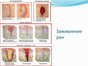 Грануляция тканей после операции. Грануляция – один из процессов заживления раны. Как выглядит грануляционная ткань