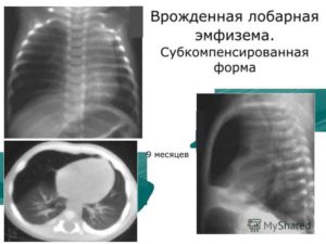 Врожденная долевая эмфизема. Интерстициальная эмфизема легких у новорожденных, симптомы и лечение. Симптомы Врожденной Долевой Эмфиземой