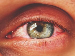 Лечение кандидозного конъюнктивита. Грибковый конъюнктивит глаз лечение у взрослых. Мази для глаз