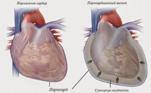 Что такое гидроперикард, причины возникновения и опасность. Гидроперикардит сердца: лечение и причины Травмы грудной клетки