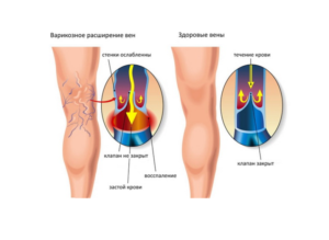 Как связаны геморрой и варикоз. Взаимосвязь варикоза и геморроя – что общего