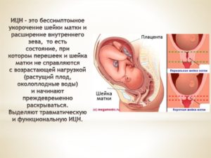 Что если шейка матки короткая. Опасно ли укорочение шейки матки при беременности и почему возникает это состояние