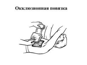 Как делается окклюзионная повязка. Алгоритм наложения окклюзионной (герметизируюшей) повязки