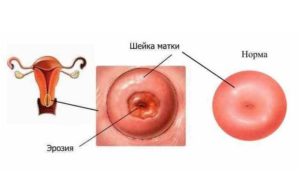 Можно ли прижигать эрозию нерожавшим. Эрозия шейки матки у нерожавших женщин. Особенности лечения