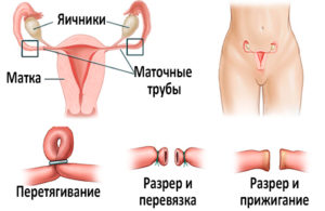 Хочу сделать стерилизацию. Женская стерилизация - стерилизация маточных труб