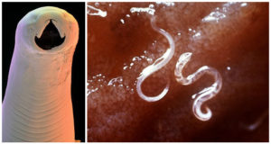 Бывают ли черные глисты в организме человека. Бывают ли черные маленькие глисты у человека