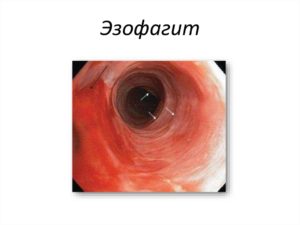 Что такое пролапс желудка. Симптомы и лечение пролапса слизистой желудка в пищевод. Признаки ГЭР, являющегося патологией