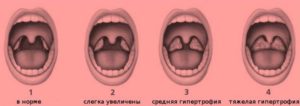 Как можно облегчить дыхание во сне ребенку с аденоидами? Можно ли задохнуться от аденоидов