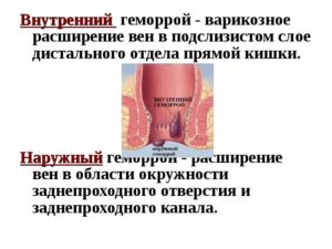 Варикоз кишечника: симптомы и диагностика. Симптомы варикоза прямой кишки