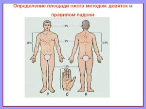 Ожоги: площадь ожогов, определение по правилу ладони. Классификация ожогов по площади и степени поражения. Методы определения площади ожога