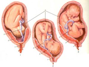 Локализация плаценты передняя стенка матки высоко. Расположение плаценты по передней и задней стенке матки