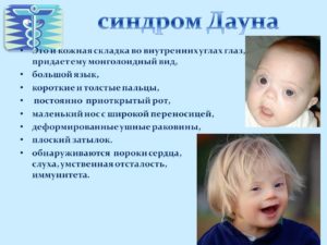 Почему дети с синдромом дауна все на одно лицо. Физическое и умственное развитие. Формы синдрома Дауна