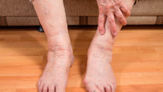 Что такое тремор конечностей. Основные причины дрожи в ногах Почему трясутся ноги у пожилых