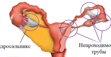 Непроходимость левой маточной трубы лечение. Непроходимость маточных труб - народные средства. Как лечить непроходимость маточных труб