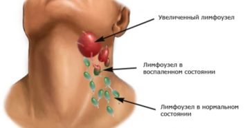 После ангины воспалились лимфоузлы на шее чем лечить. Воспаление лимфоузлов во время ангины