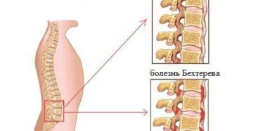 Болезнь бехтерева наследственность. Болезнь Бехтерева передается по наследству