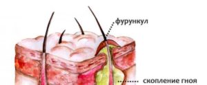 Фурункул на половых губах. Как лечить фурункул на половых губах